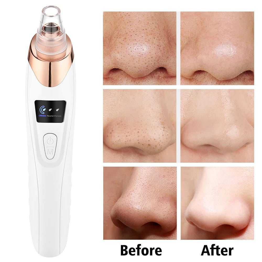Blackhead remover vacuum before and after nose pore cleaning results
