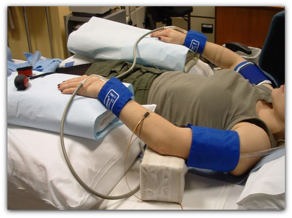 A supine participant with both forearms outstretched on padded supports, showing bilateral wrist BP cuffs, upper-arm occlusion cuffs and mercury-in-silastic strain gauges used for venous-occlusion forearm plethysmography.