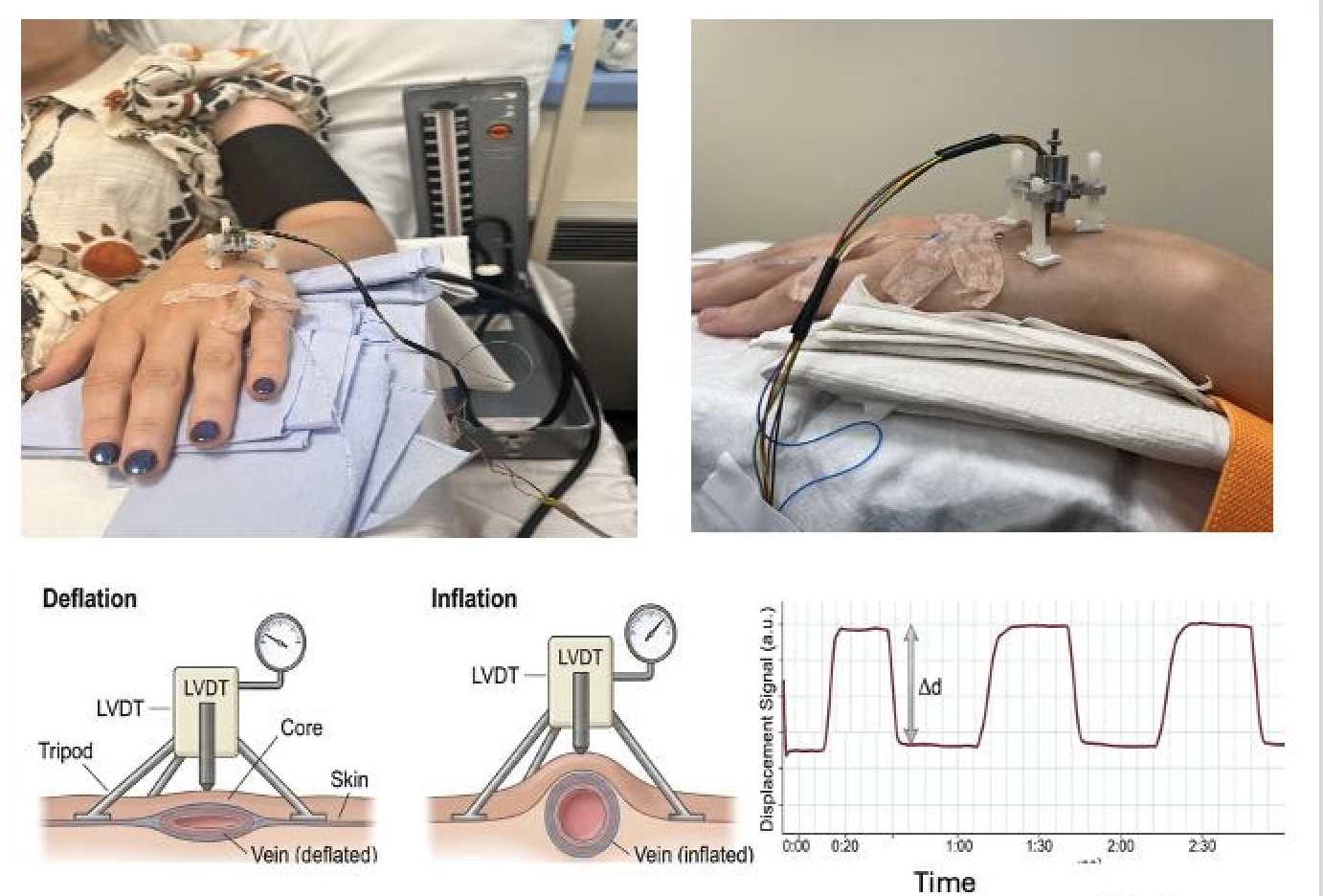 Composite figure of the Aellig hand-vein compliance technique: two photos of a participant’s cannulated dorsal hand veins with the tripod-mounted Linear Variable Differential Transformer (LVDT) sensor and mercury sphygmomanometer, paired with schematic diagrams of the LVDT during cuff deflation and inflation and an example displacement-signal tracing showing the change in vein diameter (Δd) across successive cuff cycles.