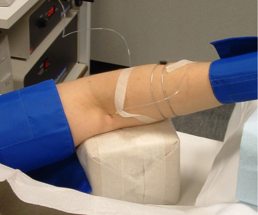 Close-up of an antecubital fossa showing a fine 27-gauge brachial-artery cannula secured with sterile tape for continuous intra-arterial infusion of vasoactive study drugs.